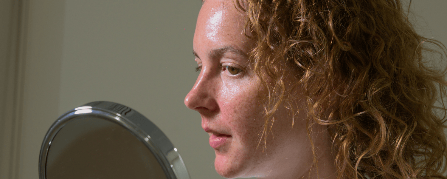 Pigmentation treatment results - melasma and hyperpigmentation correction in Abu Dhabi